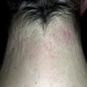 Zaskórniki otwarte na szyi