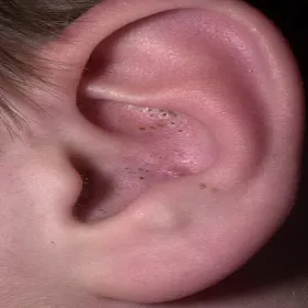 Zaskórniki otwarte w uchu