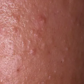 Zaskórniki zamknięte na skórze wygląd