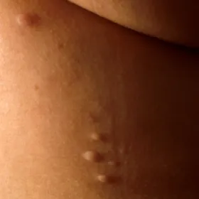 Zdjęcia chorób skóry - Zanik plamisty skóry postać guzowata