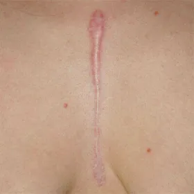 Zdjęcie bliznowce po operacji