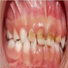 Zepsute zęby u dzieci zdjęcia