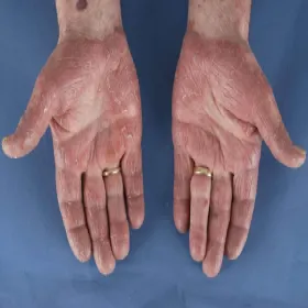 Zespół Sezary’ego na dłoniach 