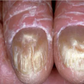 Zespół Sezary’ego na palcach, paznokciach