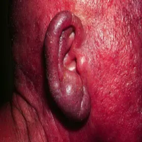 Zespół Sezary’ego wygląd