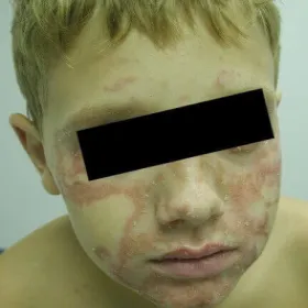 Zespół Sneddona u dziecka