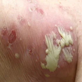 Zespół Sneddona zdjęcie