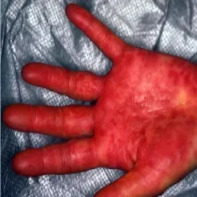 Zespół Stevensa- Johnsona na dłoni
