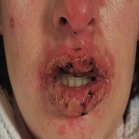 Zespół Stevensa- Johnsona na ustach