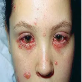 Zespół Stevensa- Johnsona oczy