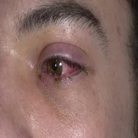 Zespół Stevensa- Johnsona oka