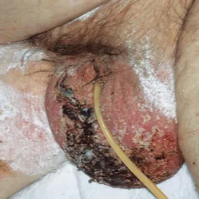 Zgorzel Fourniera na mosznie