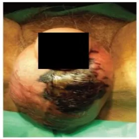 Zgorzel fourniera choroba moszny