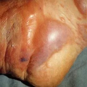 Zgorzel gazowa gangrena na stopie