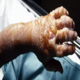 Zgorzel gazowa na dłoni