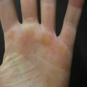 Zgrubienie skóry na dłoni