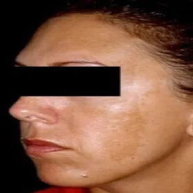 Zmiany skórne w ciąży na twarzy ostuda