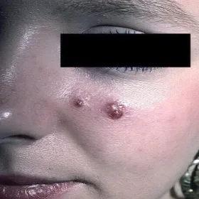 Ziarniniak naczyniowy na poliku