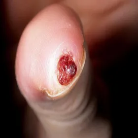 Ziarniniak pod paznokciem