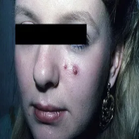 Ziarniniak ropotwórczy guzki na twarzy