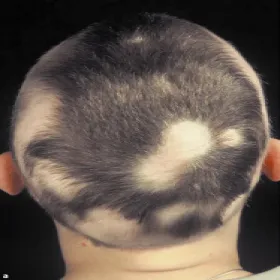 Zmiana skórna na głowie łysienie plackowate