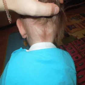 Zmiana skórna na szyi u dziecka uszczypnięcie bociana