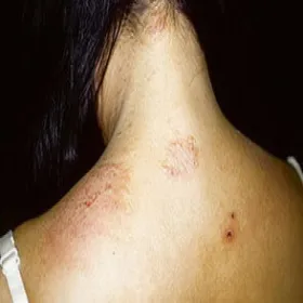 Zmiana skórna na szyi wyprysk pieniążkowaty