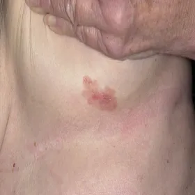 Zmiana skórna pod piersią choroba Bowena