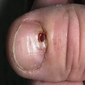 Zmiany na paznokciu ziarniniak