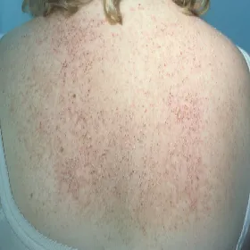 Zmiany na skórze pleców choroba Dariera