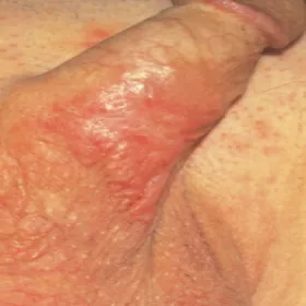 Zmiany na skórze trzonu prącia choroba pozasutkowa choroba Pageta 