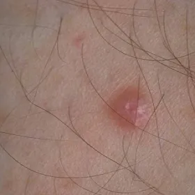 Zmiany na skórze zdjęcia włókniak twardy