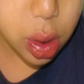 Zmiany na ustach u dziecka choroba Kawasakiego 