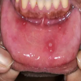 Zmiany na wardze dolnej choroba Behçeta 