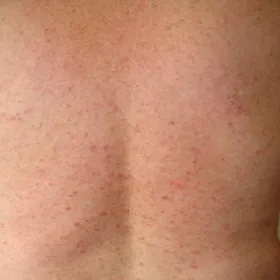 Zmiany skórne choroba Grovera