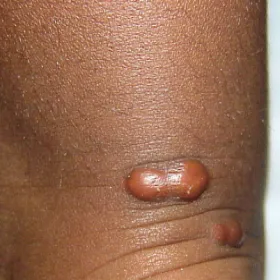 Zmiany skórne guzki kępki żółte guzowate