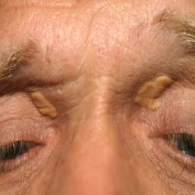 Zmiany skórne koło oczu kępki żółte 