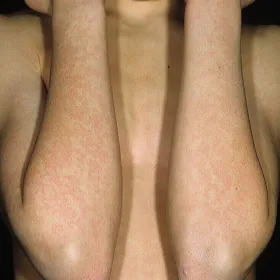 Zmiany skórne na łokciach 