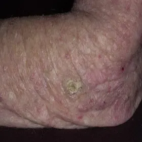 Zmiany skórne na łokciu rogowacenie słoneczne