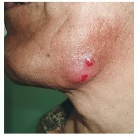 Zmiany skórne na brodzie choroba promienica