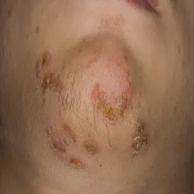 Zmiany skórne na brodzie liszajec