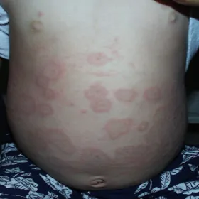 Zmiany skórne na brzuchu u dziecka 