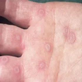 Zmiany skórne na dłoni rumień wielopostaciowy 