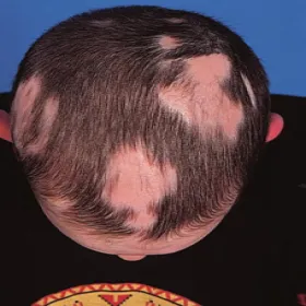 Zmiany skórne na głowie choroby łysienie plackowate