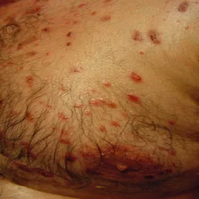 Zmiany skórne na klatce piersiowej zdjęcia pęcherzyca zwykła