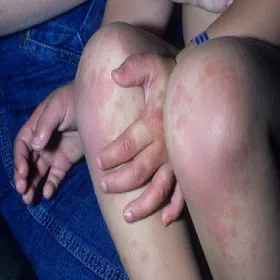 Zmiany skórne na nogach choroba Kawasakiego 