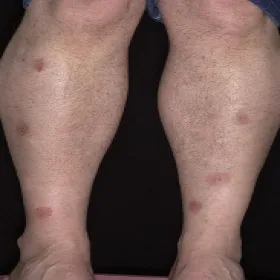 Zmiany skórne na nogach zdjęcia wyprysk pieniążkowaty