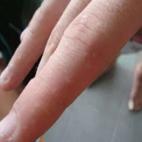 Zmiany skórne na palcach