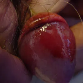 Zmiany skórne na penisie erytroplazja Queyrata