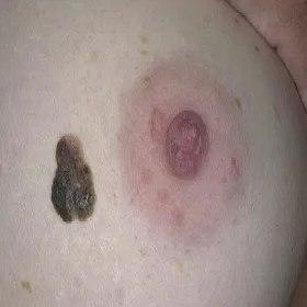 Zmiany skórne na piersi brodawka łojotokowa